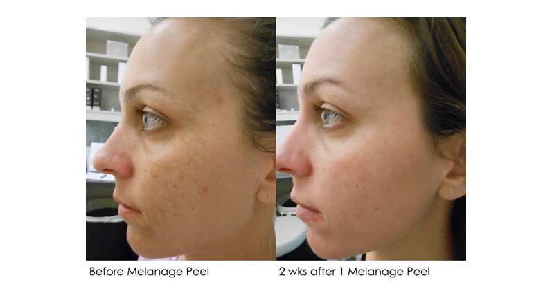 Before / After – Haley Dermatology